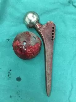 「筋骨堂」人工髋关节并非一劳永逸