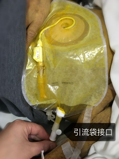 造瘘袋接引流袋怎样才能更顺畅,防逆流引流袋怎么排液
