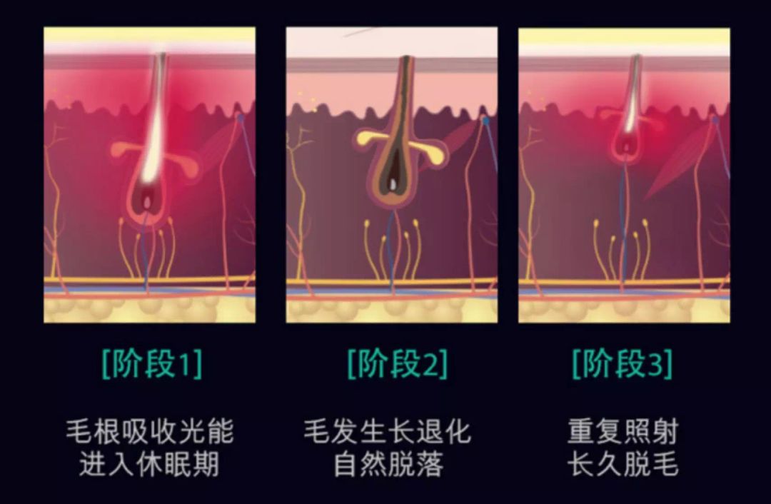 有什么办法脱毛之后不再长,怎样脱毛不再长最有效方法