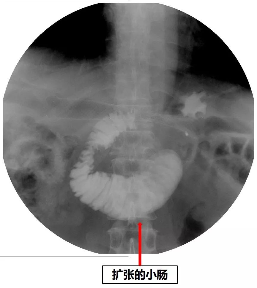 消化道支架置入术,消化道梗阻支架怎么放