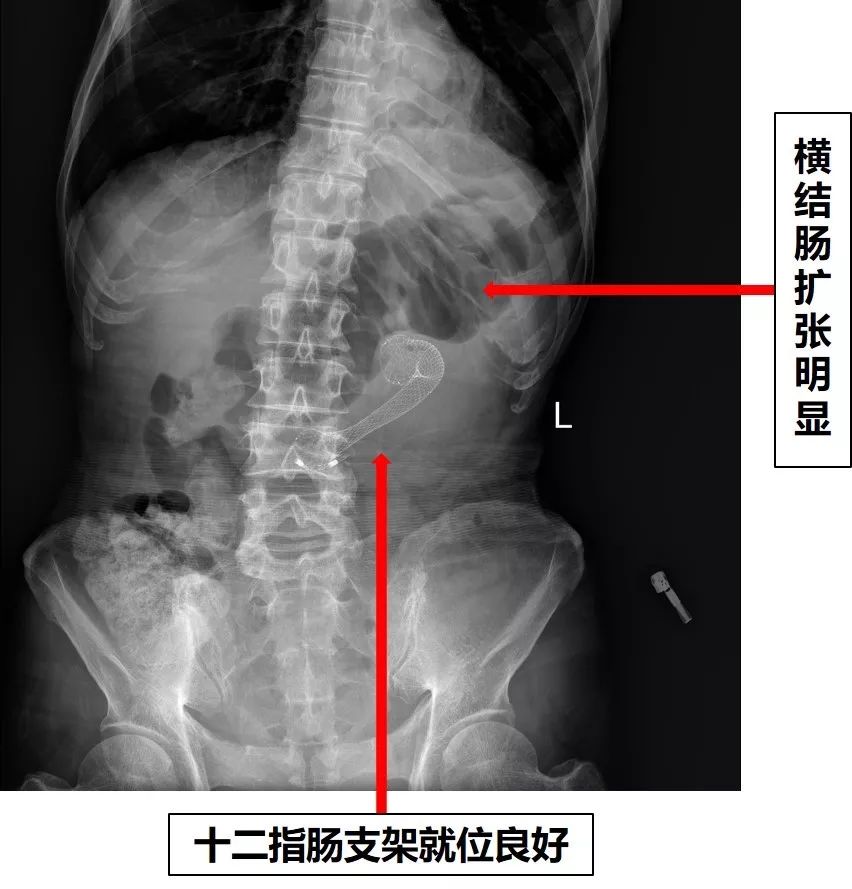 消化道支架置入术,消化道梗阻支架怎么放