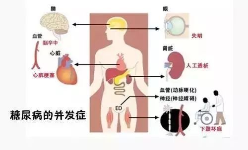 中医代金刚博士防治糖尿病,仝小林中医糖尿病防治指南