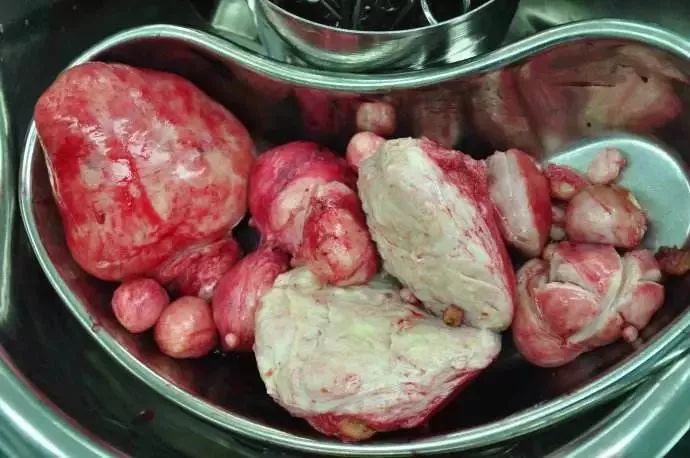 被“它”折磨的女性越来越多!医生看到她子宫里的东西——彻底惊呆了!