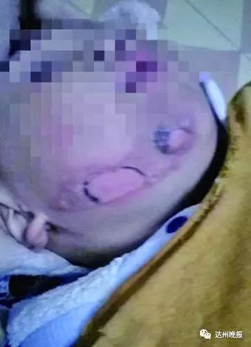 1岁幼童被烫伤还未脱险,1岁小孩被热稀饭烫伤怎么处理