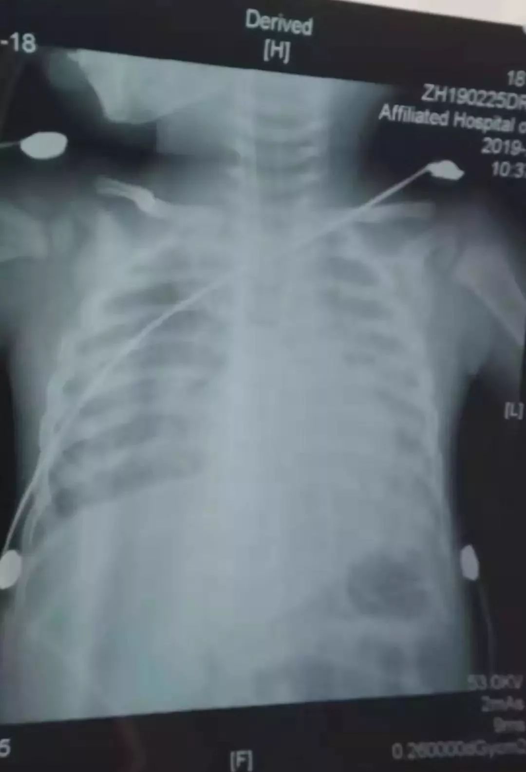 贵州1岁儿子感冒致严重后果，半个月花光夫妻三年积蓄