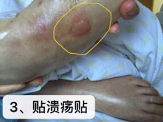 热水袋烧伤,热水袋烧伤起泡怎么处理