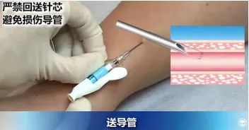 扎留置针有回血送针失败,留置针回血穿刺失败