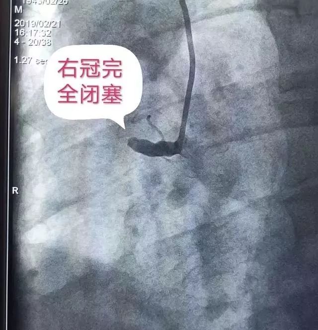 急性心肌梗死院前急救的急救措施,中医治疗急性心肌梗死的急救方法