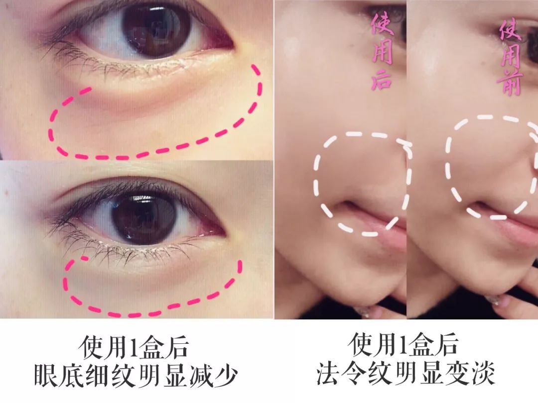 玻尿酸焕肤微晶法令纹贴 (法令纹用一支玻尿酸够了没有)