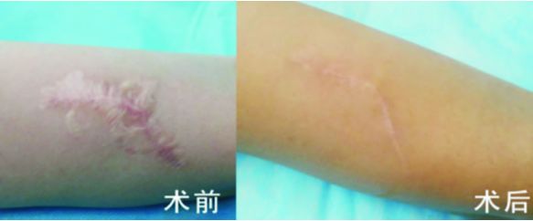 外用涂抹式肉毒素可以祛皱纹吗,去皱纹的肉毒素一年打几次为佳