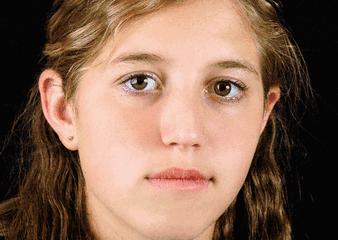 晒斑痘印去除土方法,5个祛斑小妙招淡化晒斑雀斑痘印