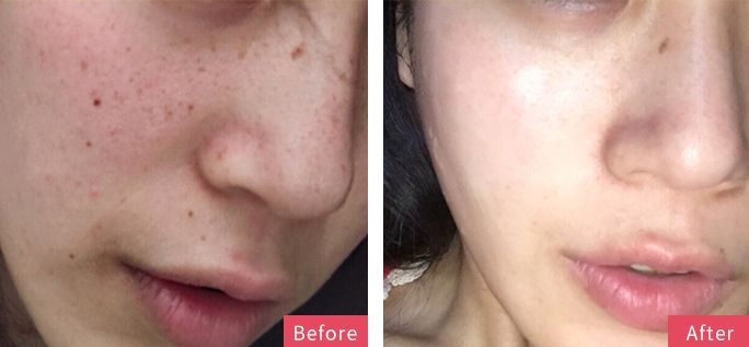 晒斑痘印去除土方法,5个祛斑小妙招淡化晒斑雀斑痘印