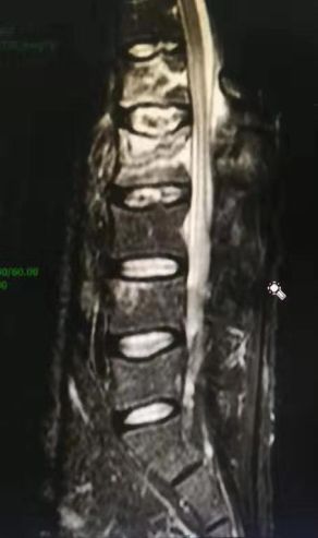 强直性脊柱炎治不好的原因,强直性脊柱炎压缩性骨折特点