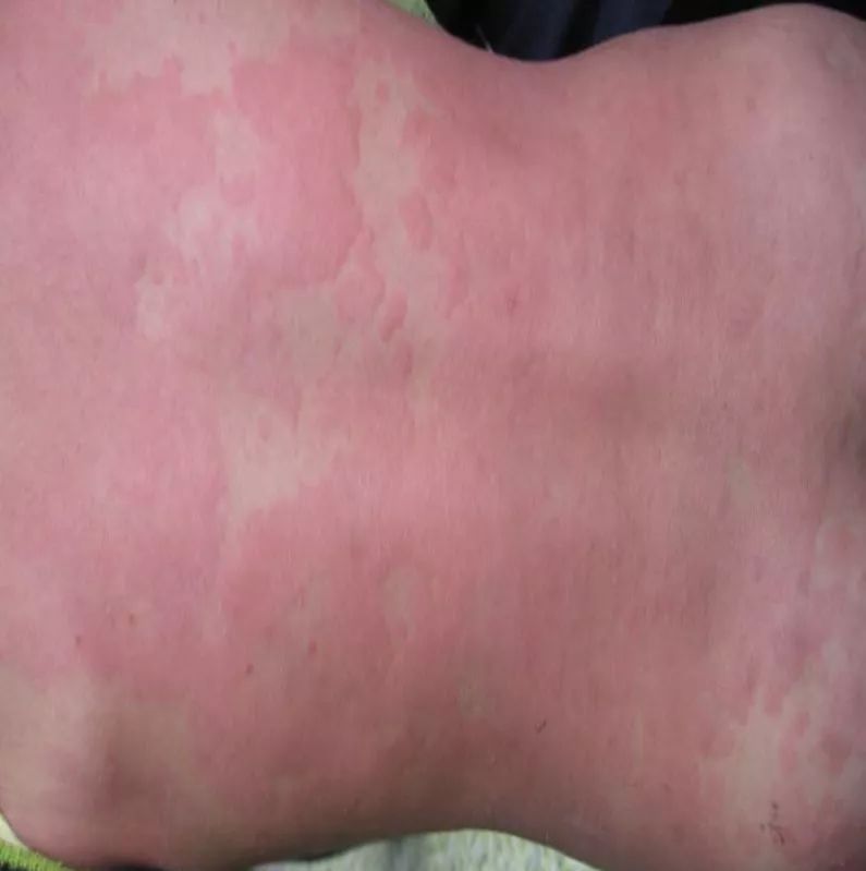 单氏中医治荨麻疹,中医治疗日光荨麻疹的最好方法