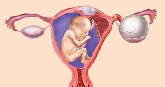 妊娠期卵巢囊肿怎么处理,妊娠期卵巢囊性块是什么东西