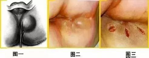 中医都有哪些药治疗肛周脓肿的,肛周脓肿是肛肠科最严重的病吗