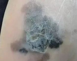 小小黑痣该不该治？该如何治？