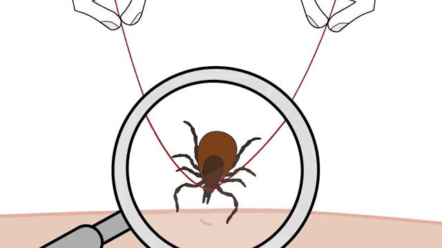 成人肚脐眼凸起肉球严重吗,成人肚脐眼凸起肉球治疗全过程