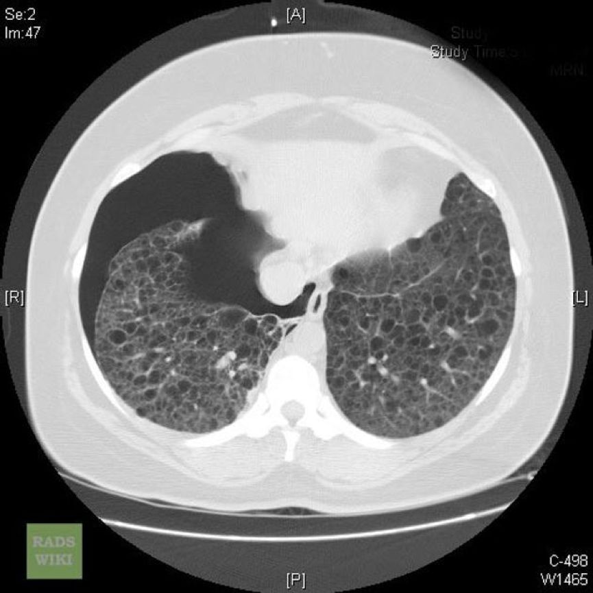 双肺上叶胸膜下见薄壁空腔正常吗,双肺多发类圆形薄壁透亮影严重吗