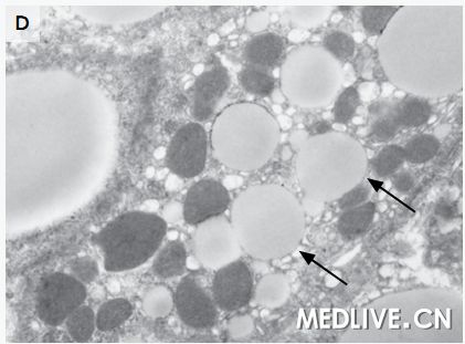 急性肝功能衰竭死亡病例,急性肝功能衰竭能彻底治好吗