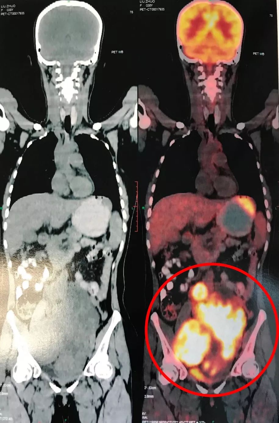 泰国回来得了白血病,泰国旅游回国后确诊淋巴瘤