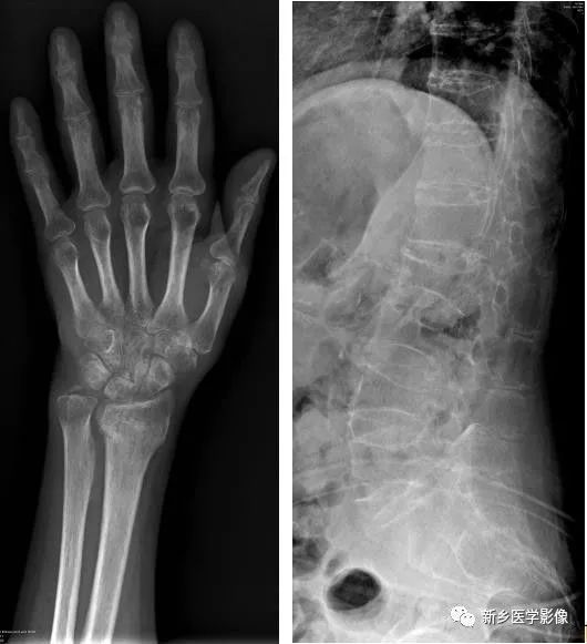 骨骼疾病怎么调理最有效,骨骼坏死最佳治疗方法