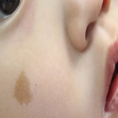 孩子为什么长咖啡斑,怀孕期间喝咖啡会不会长斑