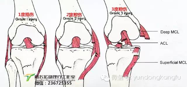 膝腓侧副韧带损伤怎么恢复,膝内侧副韧带损伤修复视频