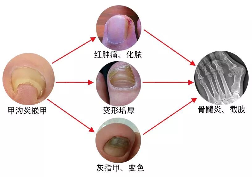 趾甲扎进肉里了，一碰就痛？用它一贴，1分钟止痛，趾甲往外长，再也不扎痛了！