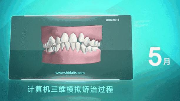 昆明龅牙矫正哪家便宜,长沙成人隐形牙齿矫正龅牙