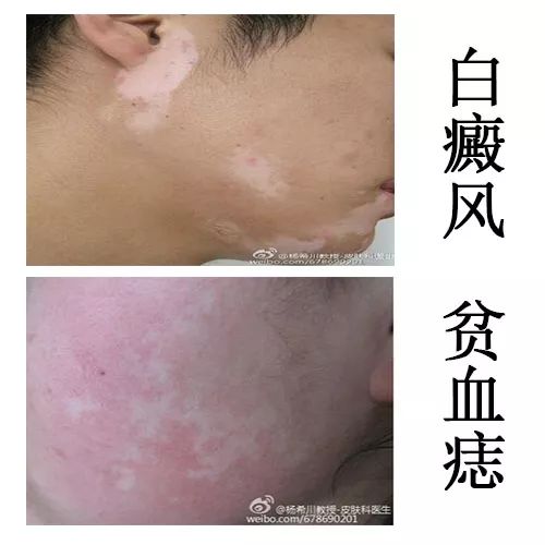 脖子突然出现白斑是不是白癜风,身上长白斑是白癜风吗如何确诊