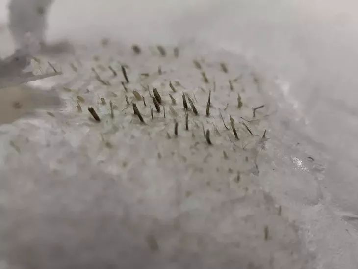 白头黑头到底拔不拔,黑头反反复复如何根治