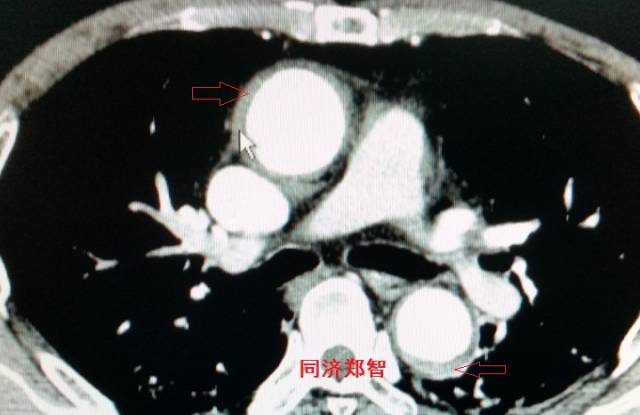 没有cta这三招也能识别主动脉夹层,磁共振可以替代cta检查主动脉夹层