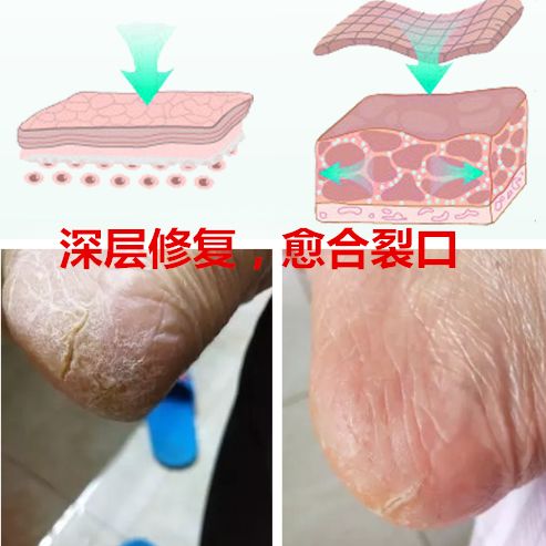 足部护理加长加热脚套,足部护理脚趾套品牌