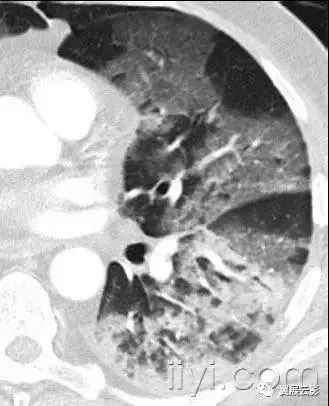 胸部解剖及常见疾病影像表现,胸部影像学基础知识