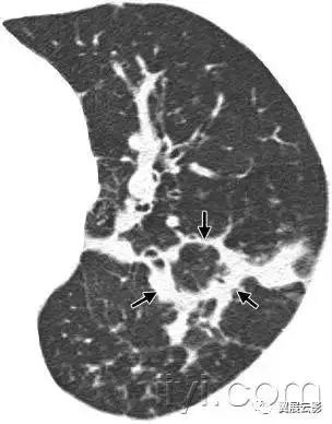 胸部解剖及常见疾病影像表现,胸部影像学基础知识