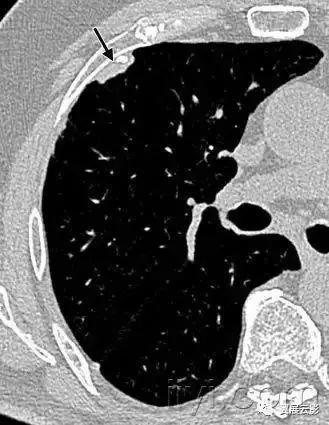 胸部解剖及常见疾病影像表现,胸部影像学基础知识