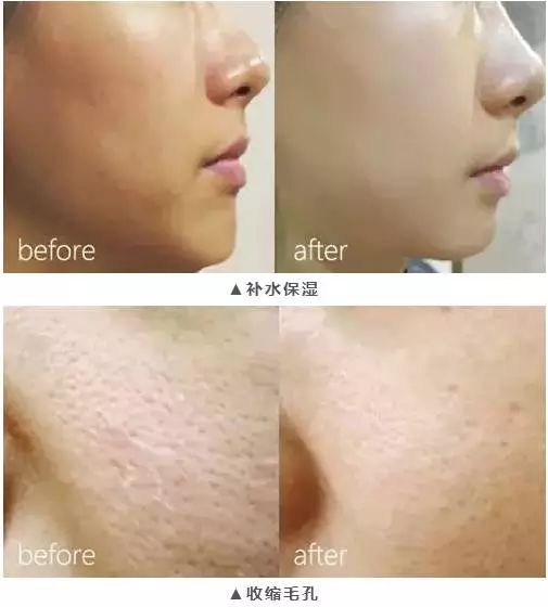 水光针副作用这么可怕,水光针有什么医疗隐患吗