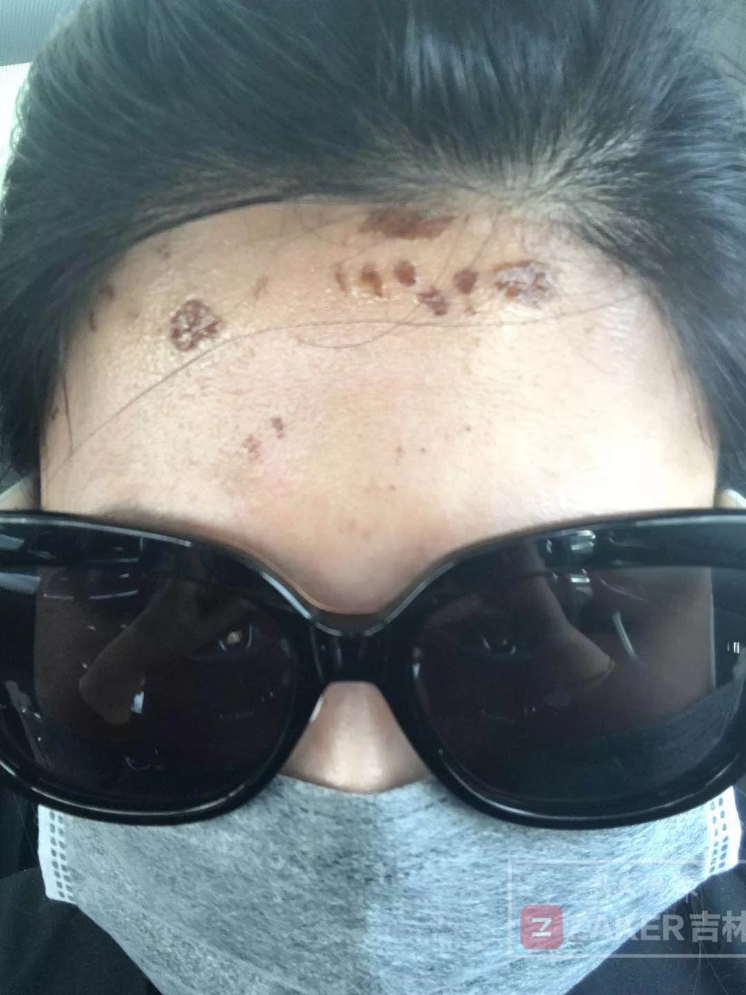 女子毁容索赔10万,女子整容失败索赔200万