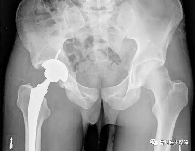 全髋置换最新技术,人工髋关节置换后可以正常跑步