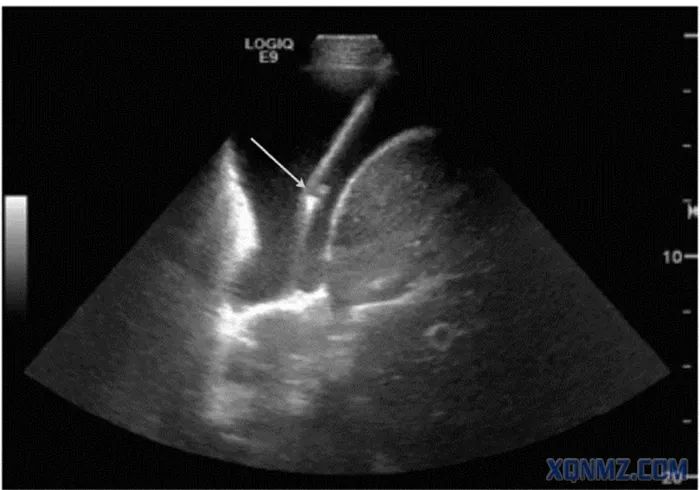 超声应用之穿刺定位
