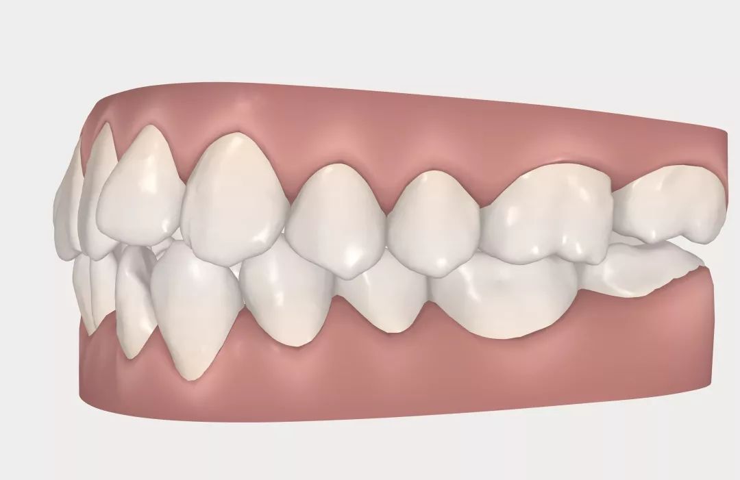 怀孕可以做乳房矫正吗,30岁哺乳期矫正牙齿的利与弊