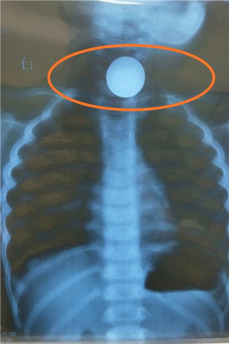 11岁男孩误吞硬币怎么办,1岁多孩子误吞硬币怎么办