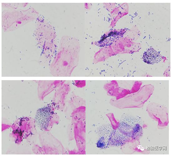 幼童患阴道炎怎么治,女幼童有点阴道炎该怎么办