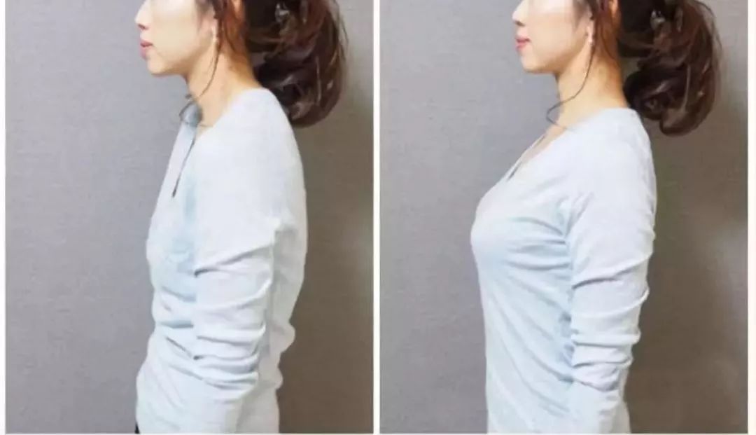 有什么方法可以改善含胸驼背,含胸驼背改善的方法