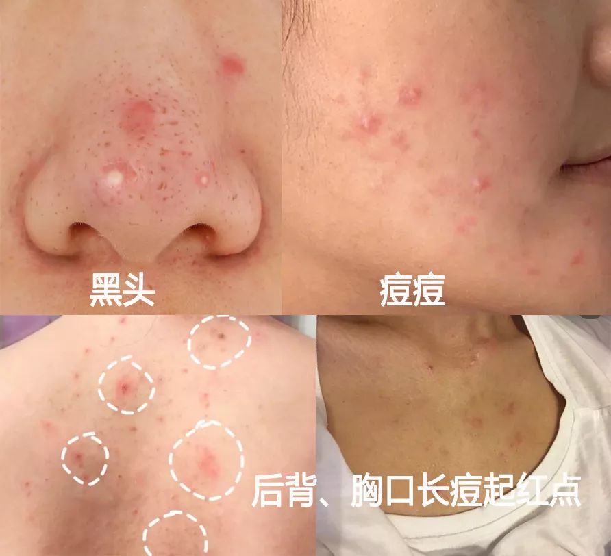 为什么能从鼻头上挤出白色的东西,鼻子挤出来的白丝是什么