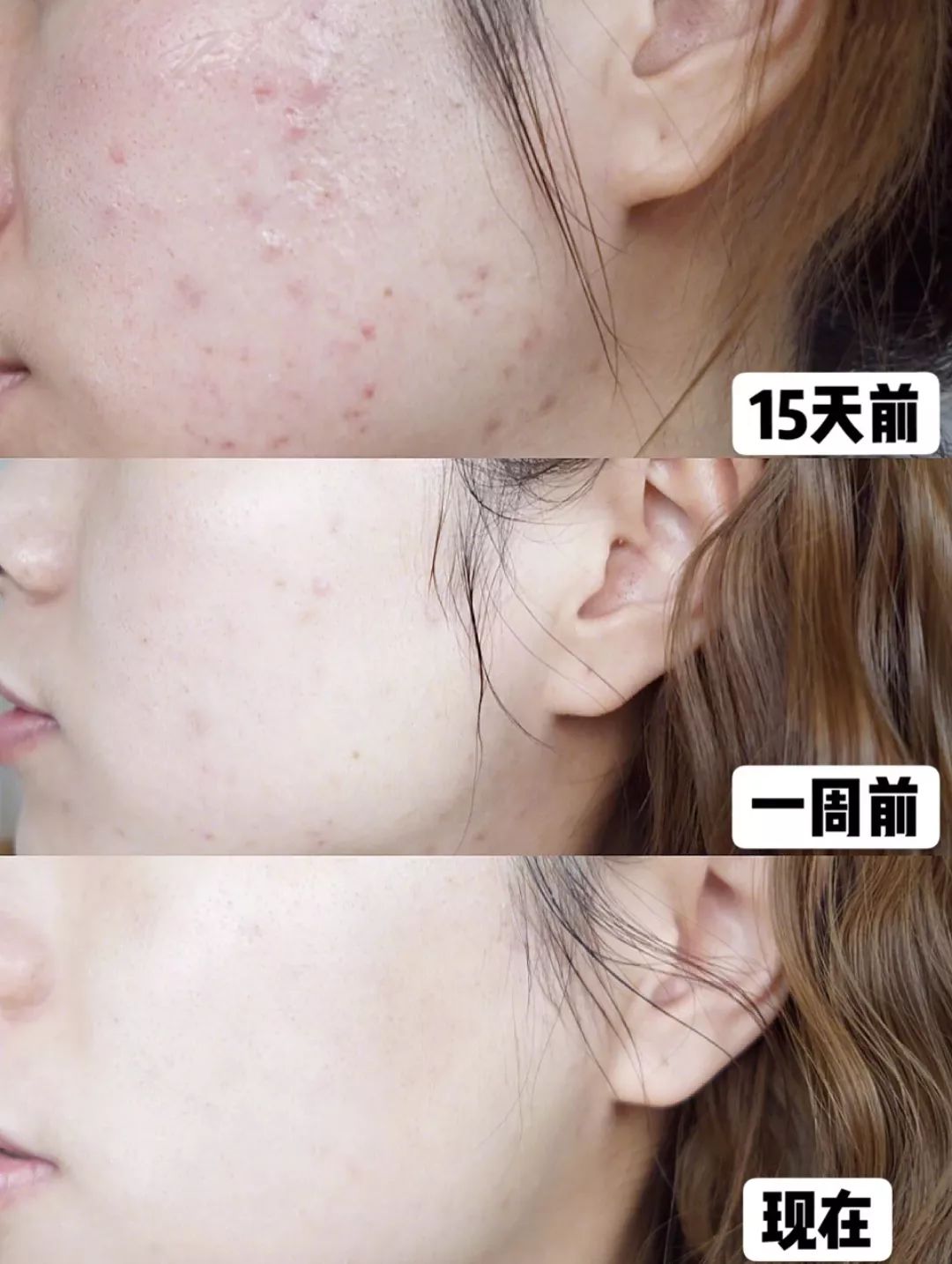 皮肤清洁出黑色的东西,皮肤挤出白色膏状很臭怎么办