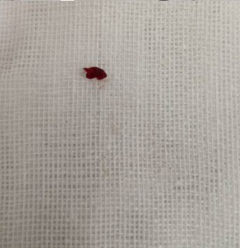 径技·例量|25期：再灌注出血—防不胜防