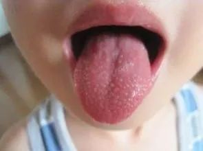 儿童感染有这些症状立即就医,有娃的要注意