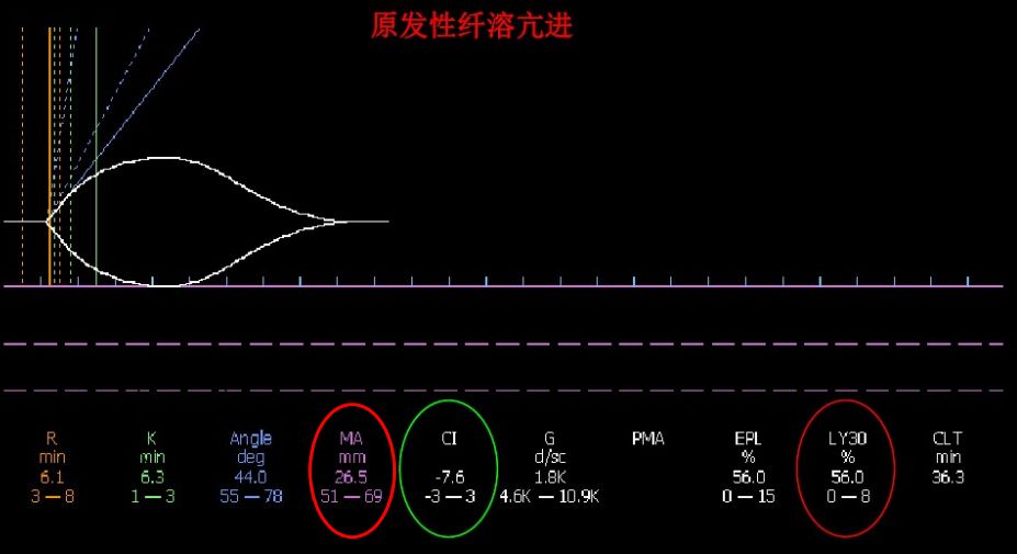 硬核区分原发性纤溶亢进与继发性纤溶亢进